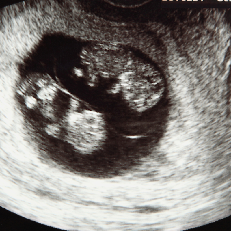 different types of twins